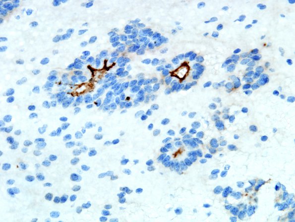 6D2 Ependymoma, focal anaplasia (Case 6) D2-40 1