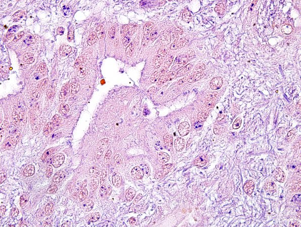 6D3 Ependymoma, focal anaplasia (Case 6) PTAH 11