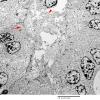 6E1 Ependymoma, focal anaplasia (Case 6) EM 012A - Copy