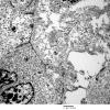 6E2 Ependymoma, focal anaplasia (Case 6) EM 014 - Copy - Copy