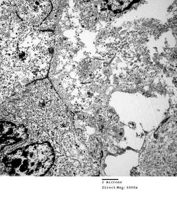 6E2 Ependymoma, focal anaplasia (Case 6) EM 014 - Copy - Copy