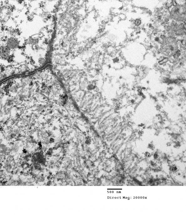 6E3 Ependymoma, focal anaplasia (Case 6) EM 015 - Copy - Copy