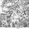 6E4 Ependymoma, focal anaplasia (Case 6) EM 016 - Copy - Copy