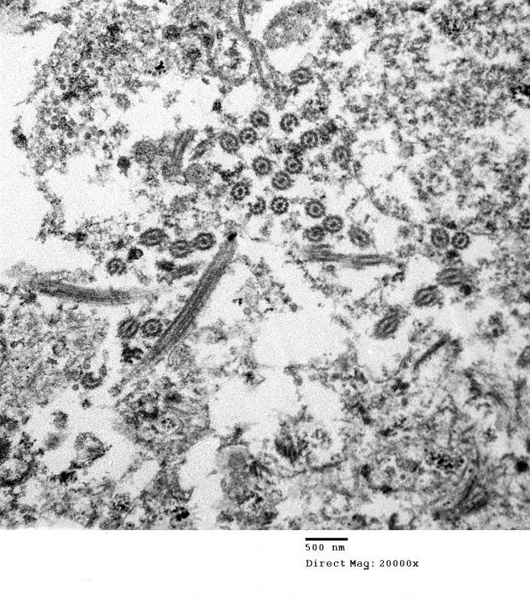 6E4 Ependymoma, focal anaplasia (Case 6) EM 016 - Copy - Copy