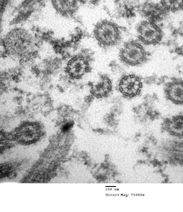 6E6 Ependymoma, focal anaplasia (Case 6) EM 019 - Copy - Copy