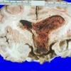 1A1 Ependymoma (Case 1) gross 1