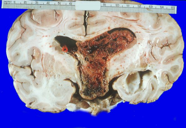 1A1 Ependymoma (Case 1) gross 1