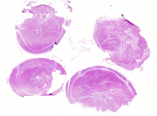 2A1 Ependymoma (Case 2) spinal H&E 2