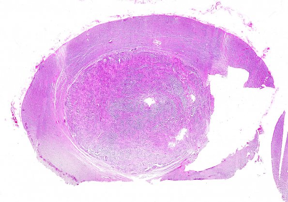 2A2 Ependymoma (Case 2) WM 2A