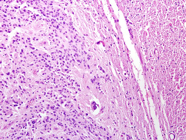 2A3 Ependymoma (Case 2) 1