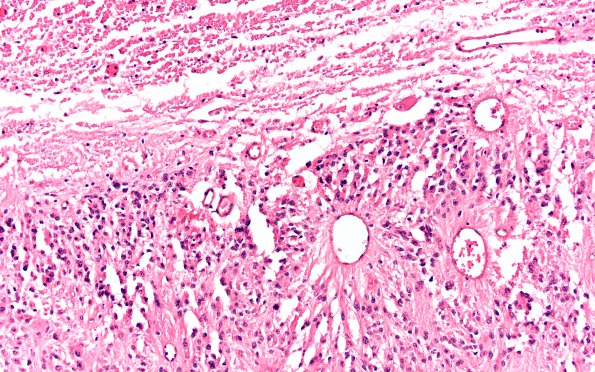 2A4 Ependymoma (Case 2) spinal H&E 20X