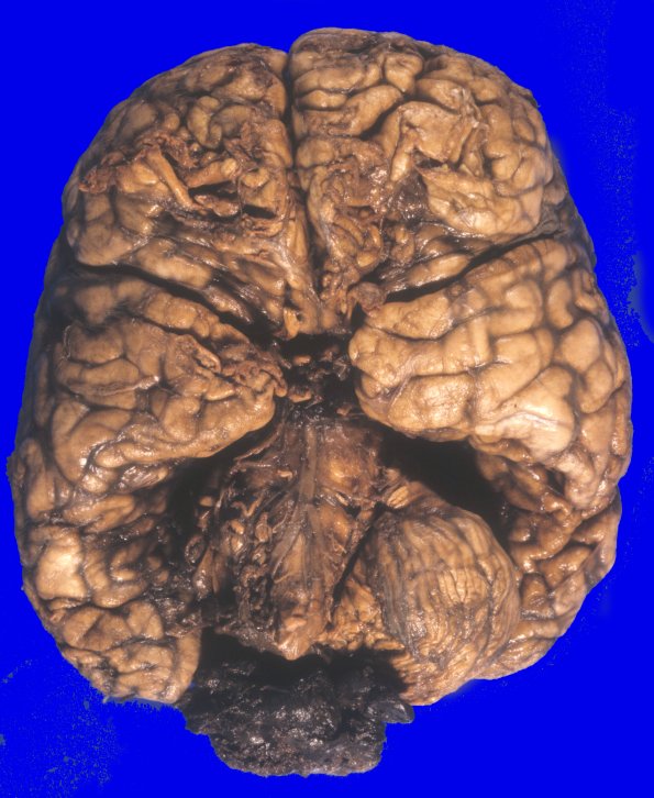 3A1 Ependymoma, anaplastic (Case 3) A2