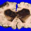 3A2 Ependymoma, anaplastic (Case 3) A1