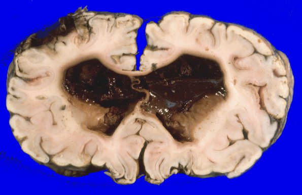 3A2 Ependymoma, anaplastic (Case 3) A1