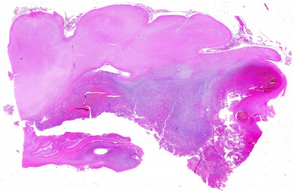 3A3 Ependymoma, anaplastic (Case 3) N7 WM (2)