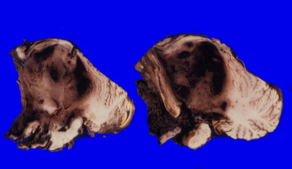 3B1 Ependymoma, anaplastic (Case 3) A3