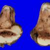 3B3 Ependymoma, anaplastic (Case 3) IV ventricle, brainstem 1