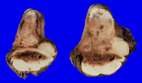 3B3 Ependymoma, anaplastic (Case 3) IV ventricle, brainstem 1