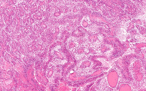 3B5 Ependymoma, anaplastic (Case 3) N6 4X