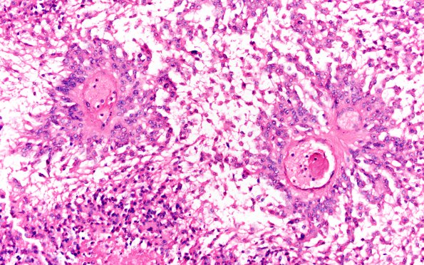 3B6 Ependymoma, anaplastic (Case 3) N6 20X