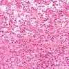 3B7 Ependymoma, anaplastic (Case 3) N8 20X