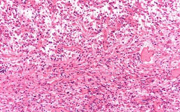 3B7 Ependymoma, anaplastic (Case 3) N8 20X