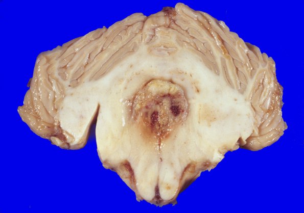 4A1 Ependymoma, (Case 4) WHO Gr 3