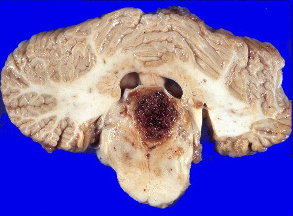 4A2 Ependymoma, IV Ventricle growth (Case 4)