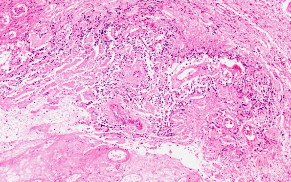 4B1 Ependymoma, IV Ventricle growth (Case 4) H&E 10X