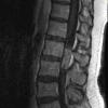 5A1 Ependymoma (Case 5), mimicking MPE, L2, T1 W 2 - Copy