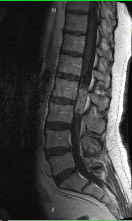 5A1 Ependymoma (Case 5), mimicking MPE, L2, T1 W 2 - Copy