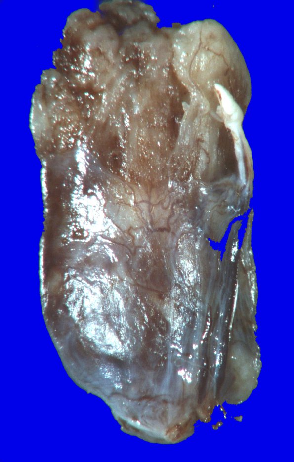 5B1 Ependymoma (Case 5), mimicking MPE, Gross 2