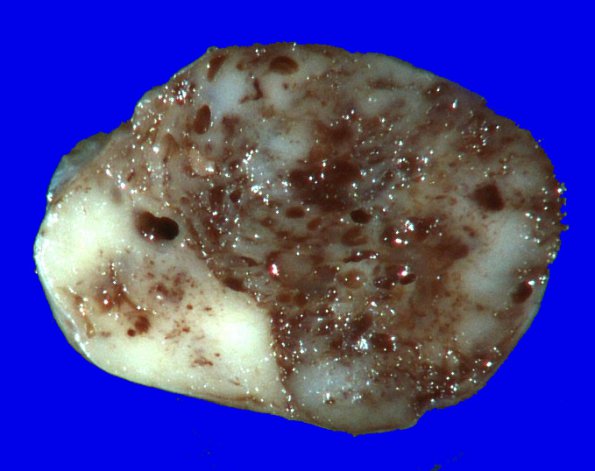 5B2 Ependymoma (Case 5), mimicking MPE, L2, Gross 3