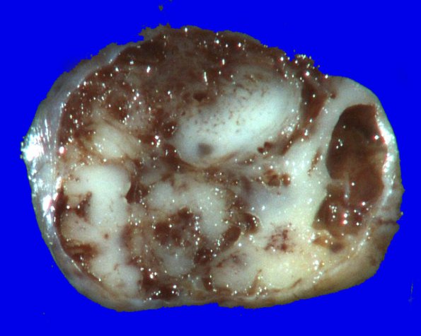 5B3 Ependymoma (Case 5), mimicking MPE, L2, Gross 4