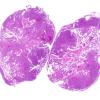 5C1 Ependymoma (Case 5), mimicking MPE H&E whole mount