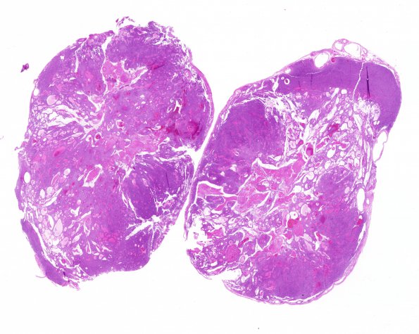 5C1 Ependymoma (Case 5), mimicking MPE H&E whole mount