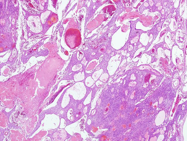 5C2 Ependymoma (Case 5), mimicking MPE, L2, H&E 7