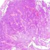 5C3 Ependymoma (Case 5), mimicking MPE, L2, H&E 6