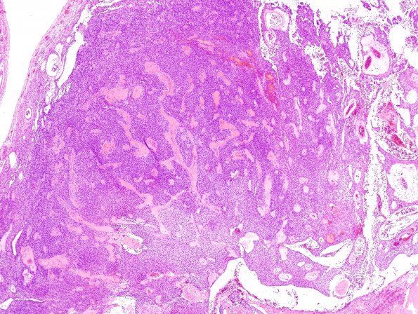 5C3 Ependymoma (Case 5), mimicking MPE, L2, H&E 6