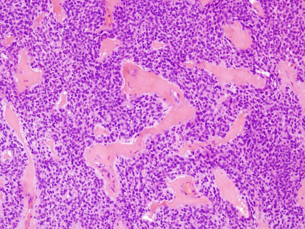 5C4 Ependymoma (Case 5), mimicking MPE, L2, H&E 5