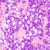 5C6 Ependymoma (Case 5), mimicking MPE, L2, H&E 1