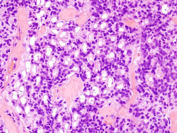 5C6 Ependymoma (Case 5), mimicking MPE, L2, H&E 1