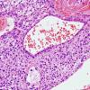 5C7 Ependymoma (Case 5), mimicking MPE, L2, H&E 3