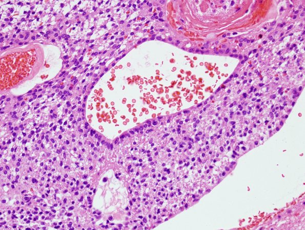 5C7 Ependymoma (Case 5), mimicking MPE, L2, H&E 3