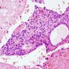 5C8 Ependymoma (Case 5), mimicking MPE, L2, H&E 4