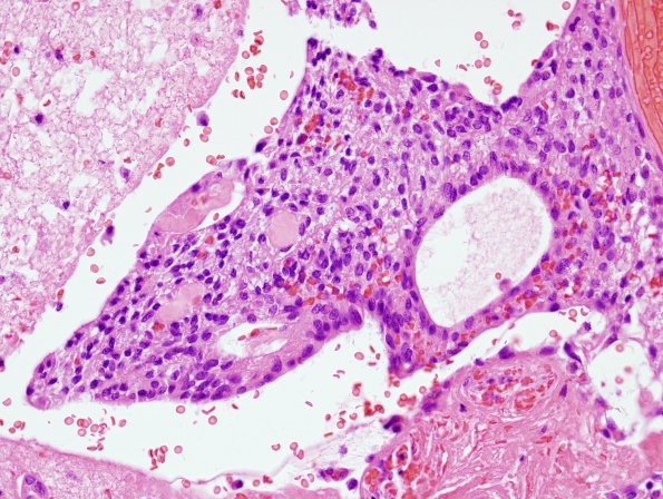 5C8 Ependymoma (Case 5), mimicking MPE, L2, H&E 4