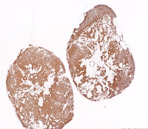 5D1 Ependymoma (Case 5), mimicking MPE, GFAP whole mount