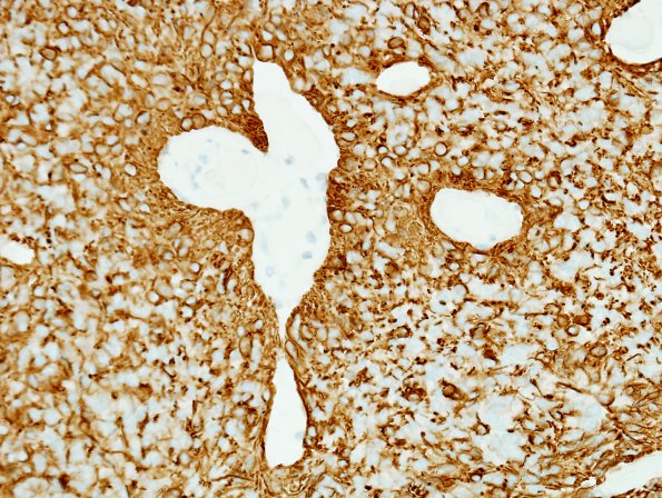 5D2 Ependymoma (Case 5), mimicking MPE, GFAP 1