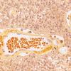 5F2 Ependymoma (Case 5), mimicking MPE, L2, Mucicarmine 40X