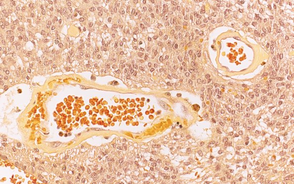 5F2 Ependymoma (Case 5), mimicking MPE, L2, Mucicarmine 40X